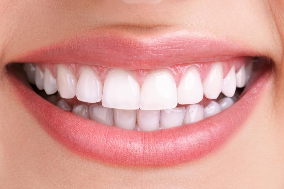 Clareamento dental